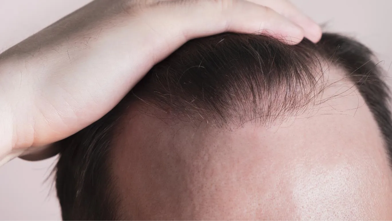 efter hårtransplantaiton