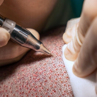 hårtransplantation göteborg