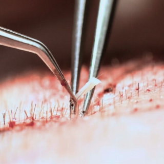 metod och teknik hårtransplantation