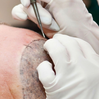 metoder för hårtransplantation