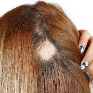 sjukdom vid kvinnligt håravfall