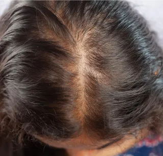 beskrivning av ärftligt håravfall kvinnor