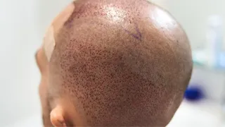 råd efter hårtransplantation