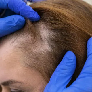 bakomliggande orsaker till kvinnligt håravfall