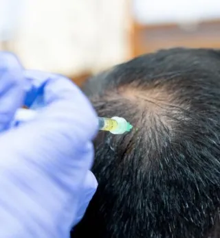 prp för kvinnligt håravfall