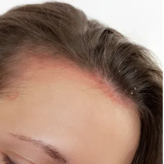 inflammatoriska tillstånd vid kvinnligt håravfall