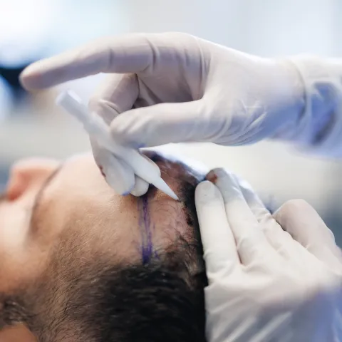 metod och teknik hårtransplantation