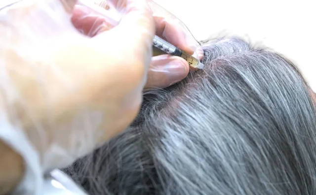 behandling av håravfall