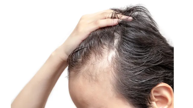 behandling av håravfall