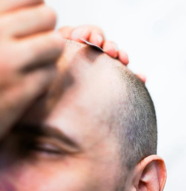 konsultation vid hårtransplantation