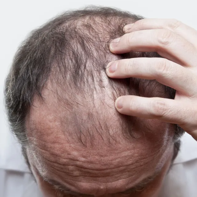 lär dig mer om håravfall