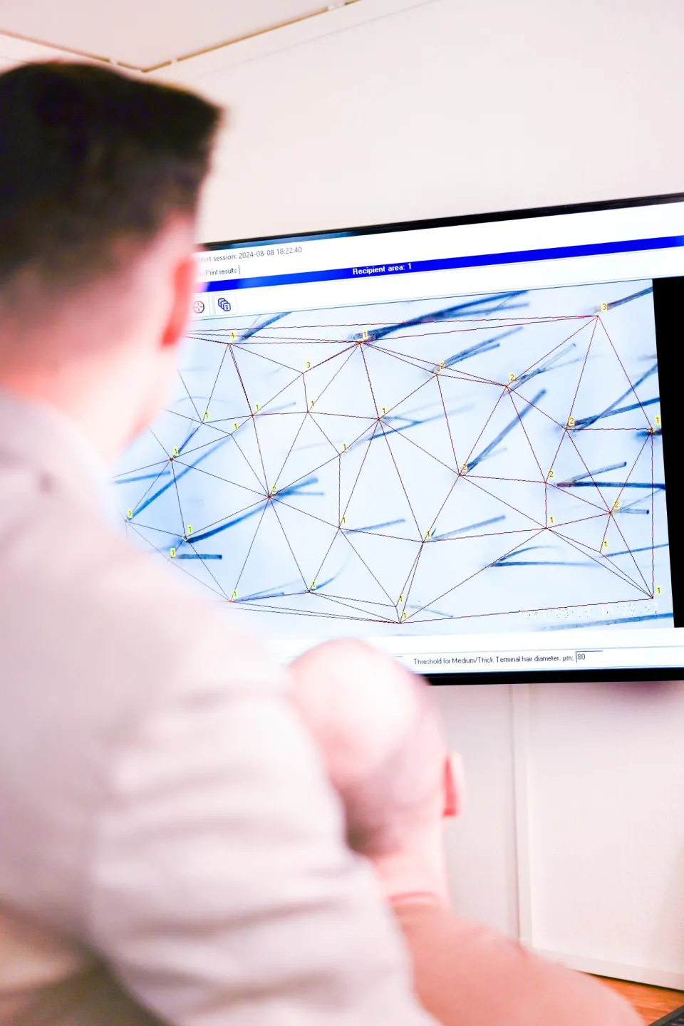 hårtransplantation eftervård