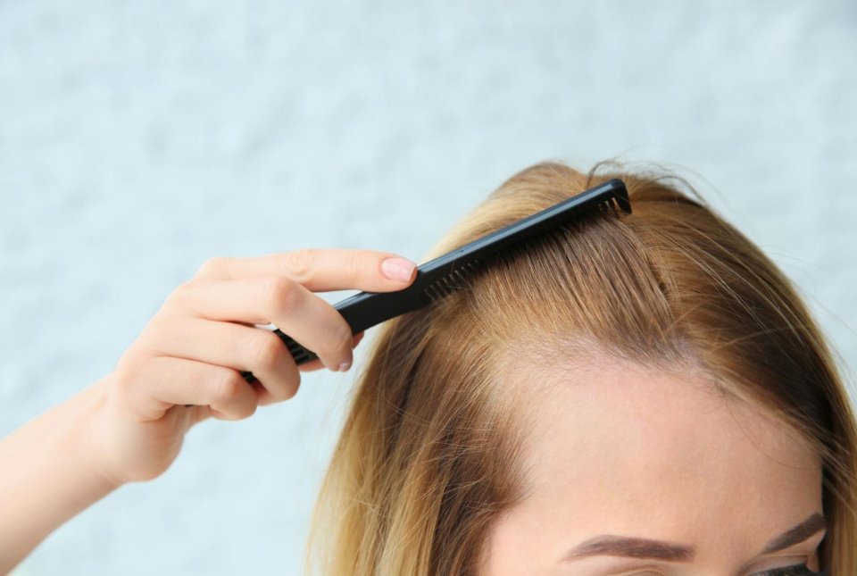 hårtransplantation göteborg