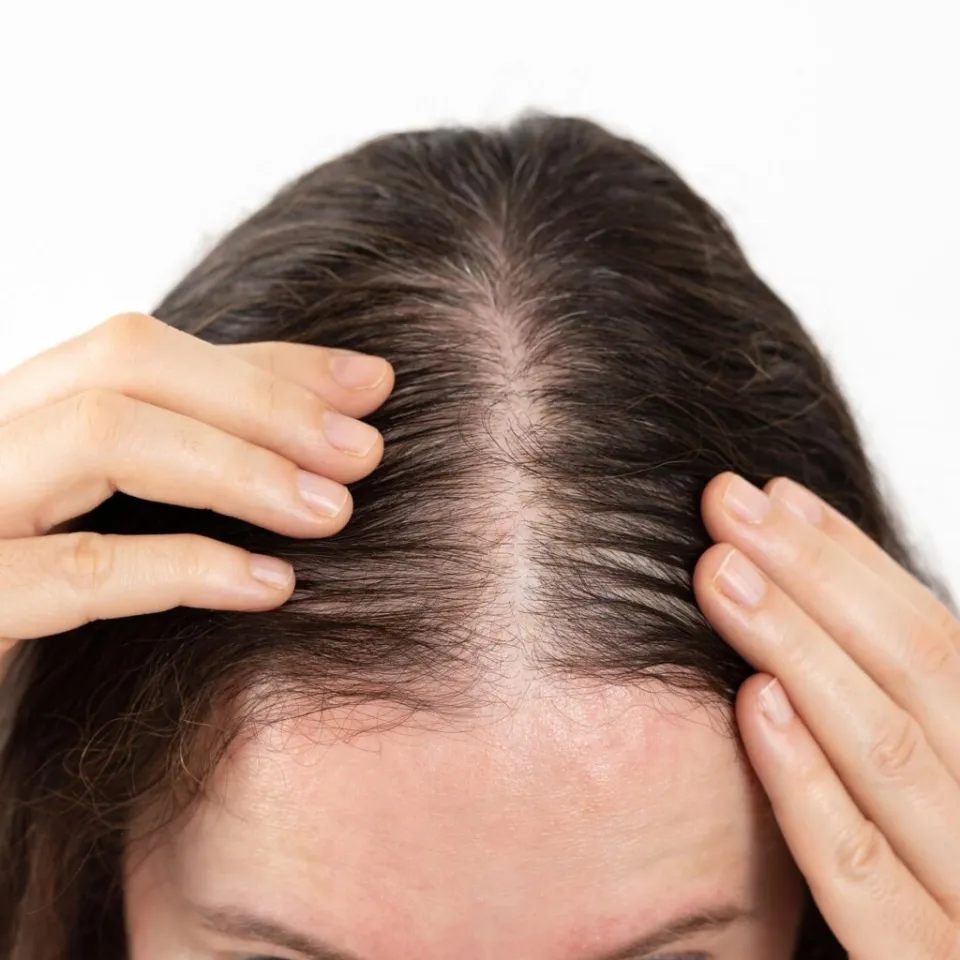 grundläggande analys vid kvinnligt håravfall