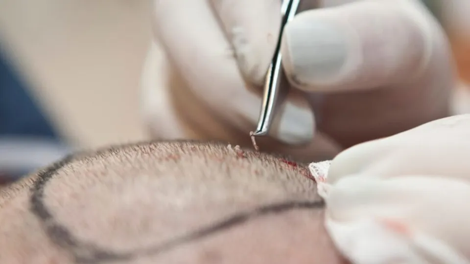 metoder för hållbar hårtransplantation