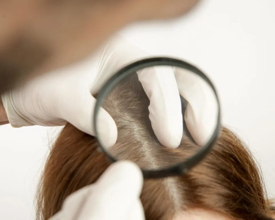 behandling för kvinnligt håravfall